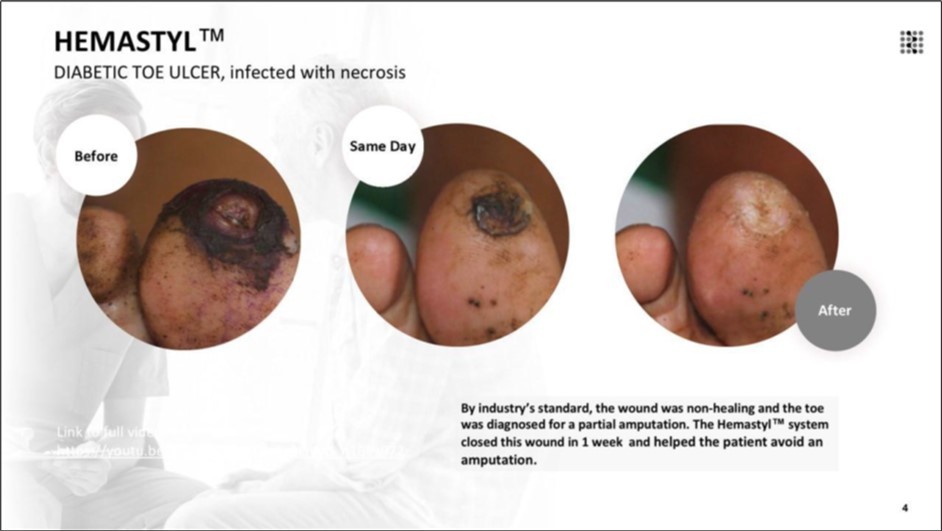The wound was classified as non-healing according to standard clinical criteria, and the patient was indicated for partial toe amputation. With the Hemastyl™ System, the wound successfully closed in 4 months and the patient avoided amputation.