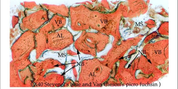 Article: Use of a Novel Exogenous Allogeneic Multi-Growth Factor Concentrate in Bone Regeneration of the Mandible: A Case Report